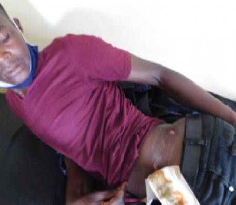 Andrew Musinguzi shows the gunshot wounds at Kanungu Health Centre IV