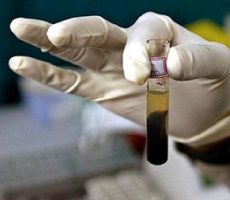 In 2019 Cameroon reported 12,000 new cases of hepatitis B